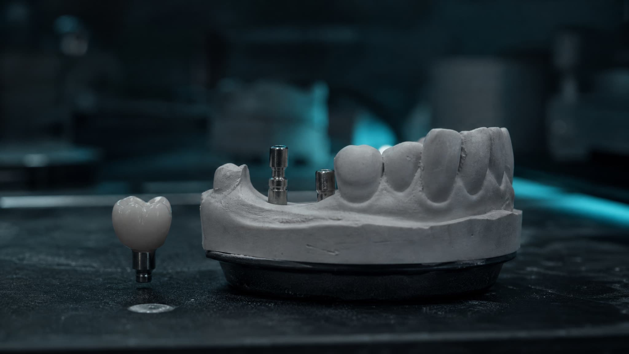 Implantatarbeit auf dem Laborsattelmodell, verschraubtes Abutment im Modell, fertige Krone daneben.